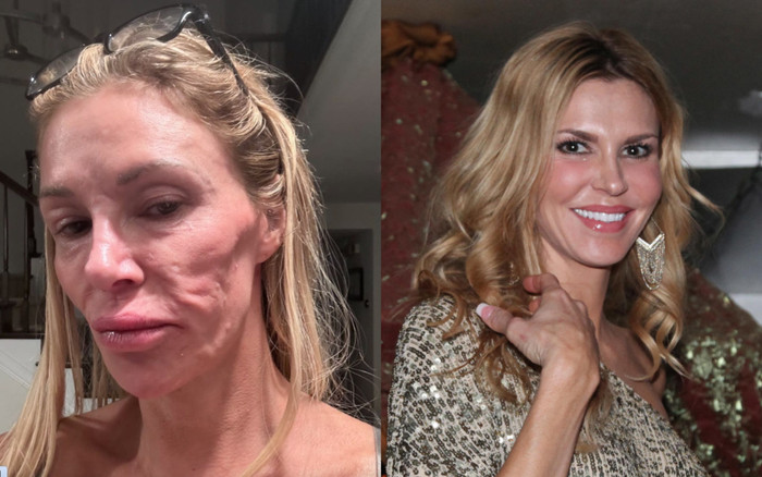 Cựu người mẫu loại bỏ toàn bộ filler trên mặt vì khủng hoảng 'ký sinh trùng' Ảnh 2