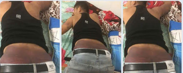 Anh Lê Văn Quí bị đánh đập, chích điện khi bị bắt sang Campuchia, đang điều trị ở Bệnh viện Chợ Rẫy. Ảnh: T.T