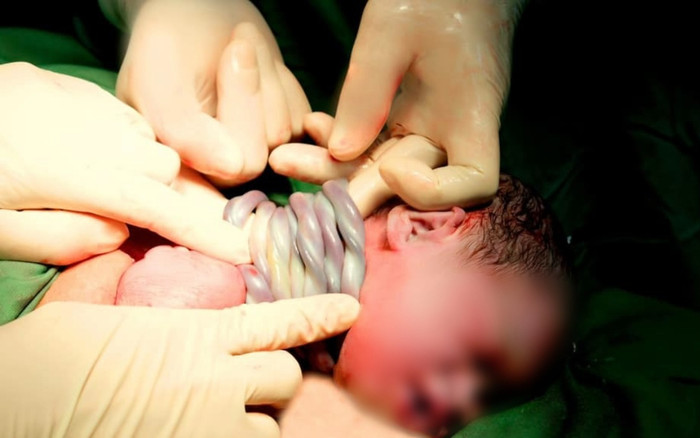 Bé gái Hà Nội chào đời kỳ diệu với 9 vòng dây rốn quấn cổ Ảnh 2
