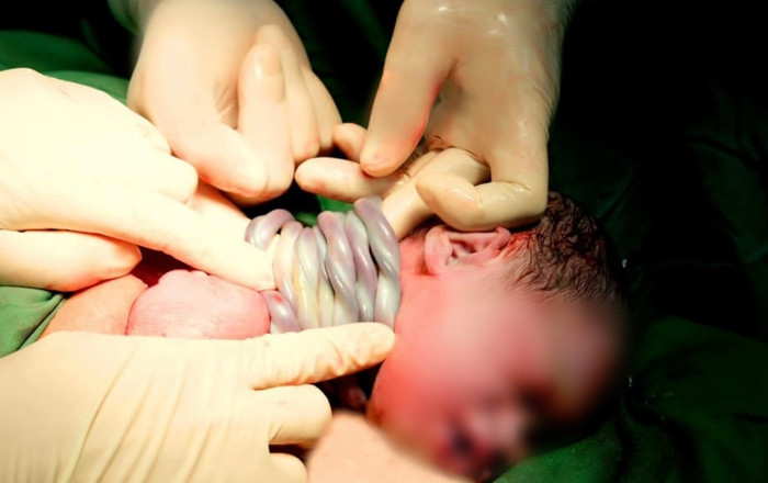 Em bé 'vượt thử thách' 9 vòng dây rốn quấn cổ chào đời khỏe mạnh.