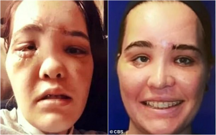 Diện mạo bị biến dạng của người mẫu Nicole Sincavage sau tai nạn xe hơi.