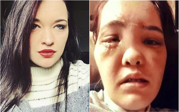 Nữ người mẫu bị gãy xương mặt vì tai nạn xe hơi giờ ra sao? Ảnh 2