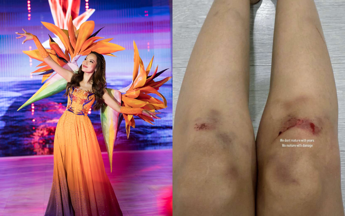 Lê Hoàng Phương gặp chấn thương khi dốc sức tập luyện để biểu diễn tại Bước Nhảy Hoàn Vũ. Ảnh: FBNV