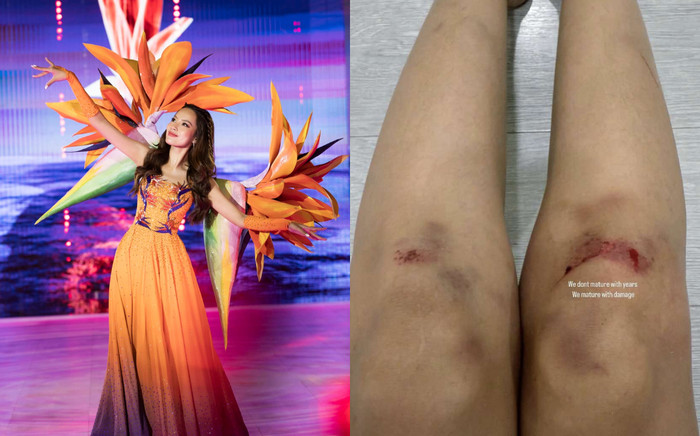 Một nàng hậu tiếp tục gặp chấn thương tại Bước Nhảy Hoàn Vũ, chân chi chít vết bầm Ảnh 2