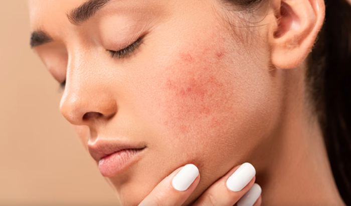 Khi kích ứng da do mỹ phẩm, bước đầu tiên chính là việc ngưng sử dụng sản phẩm đó. (Ảnh sưu tầm)