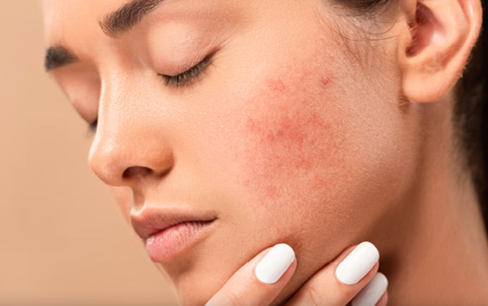 Nên làm gì để giảm thiểu tình trạng kích ứng da do mỹ phẩm? Ảnh 2