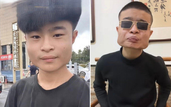 Ăn món này suốt 8 năm, chàng trai 18 tuổi gây sốc với khuôn mặt biến dạng Ảnh 2