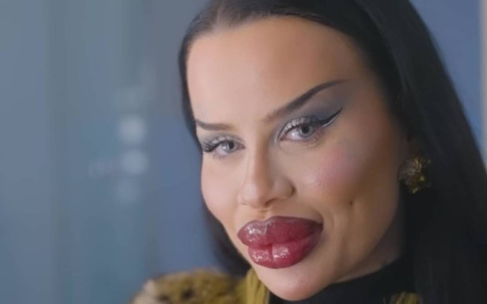 Diện mạo gây choáng của cô gái chi 1,5 tỷ tiêm botox Ảnh 2