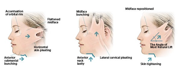 Nên căng da mặt hay tiêm filler để níu kéo 'tuổi xuân'? Ảnh 2