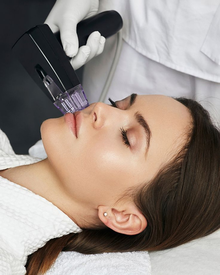 Morpheus8 kết hợp công nghệ vi kim và sóng tần số vô tuyến để kích thích sản sinh collagen.