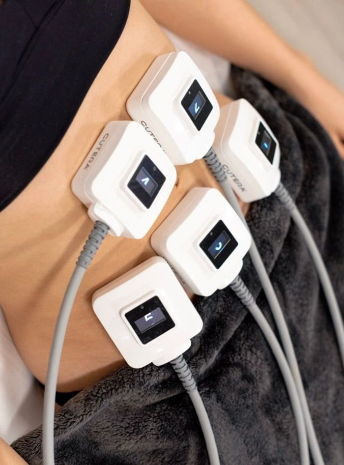 TruSculpt là giải pháp hiện đại giúp làm tan mỡ cứng đầu bằng cách sử dụng sóng Tần số vô tuyến.