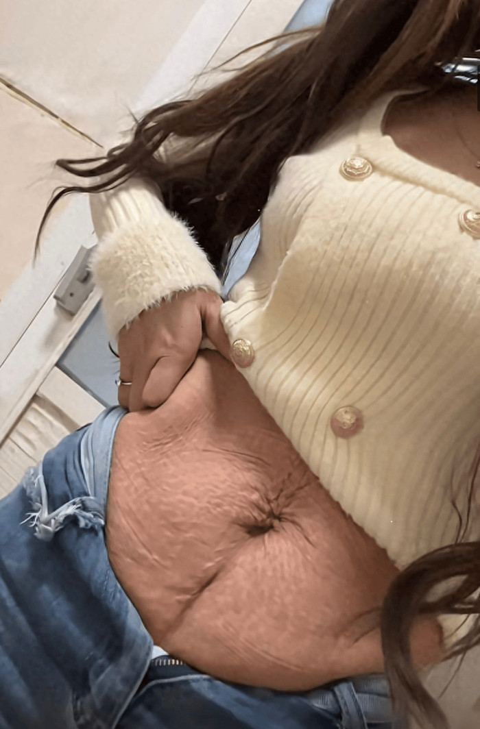 Vùng bụng sau sinh của mẹ 26 tuổi khiến dân mạng tranh cãi.