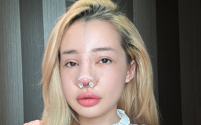 Choáng với chi phí sửa mũi lần thứ 11 của Ngân 98 Ảnh 2