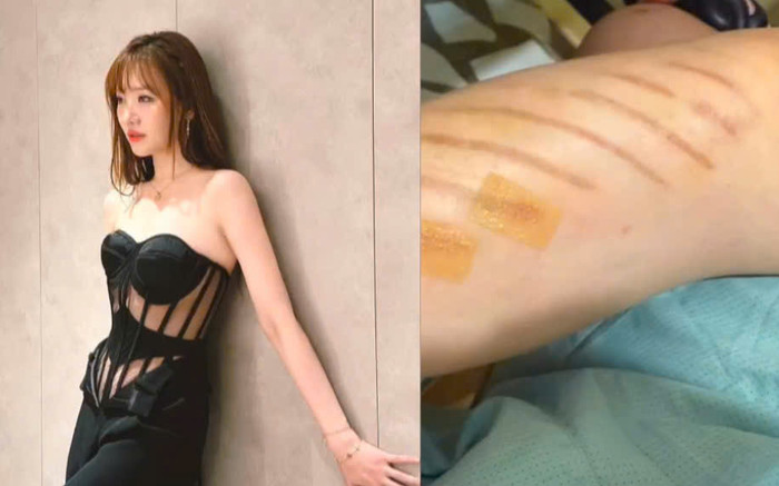 Hari Won gặp chấn thương Ảnh 2