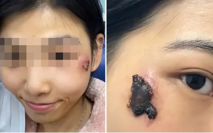 Nặn mụn nhỏ trên mặt, cô gái 20 tuổi suýt tử vong Ảnh 2