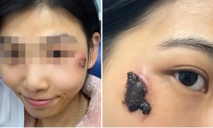 Nặn mụn sai cách, cô gái trẻ nhập viện nguy kịch vì nhiễm trùng.