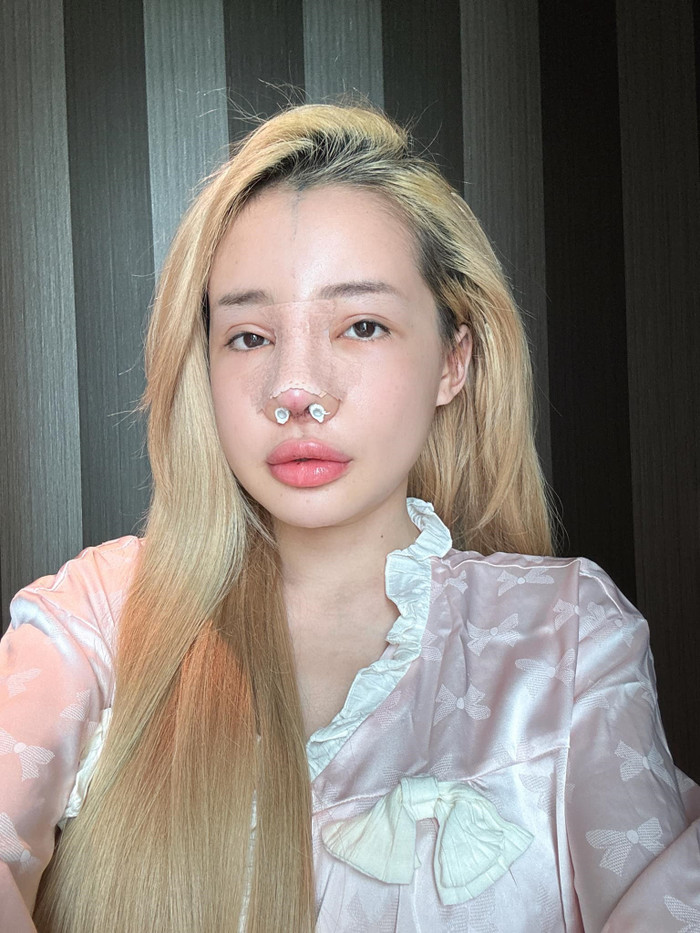 Ngân 98 phải nhập viện càng sớm càng tốt vì tình trạng mũi bị nhiễm trùng cũng như liên tục chảy mủ, gây đau nhức. (Ảnh FBNV)