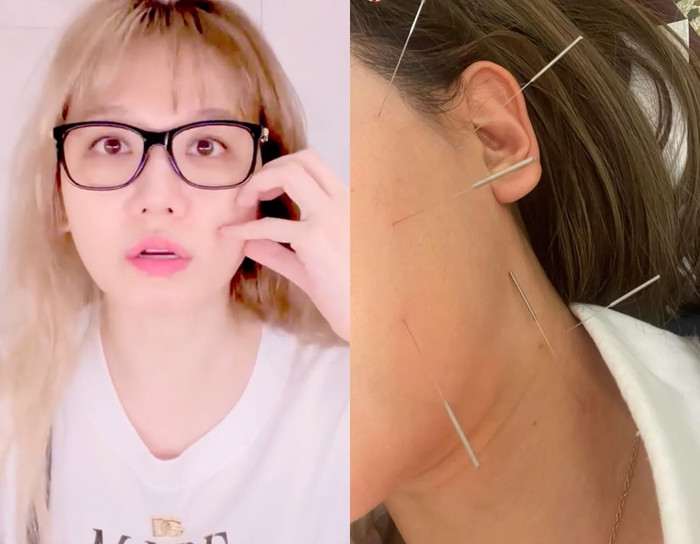 Cách đây 2 năm, Hari Won bị liệt cơ mặt. (Ảnh FBNV)