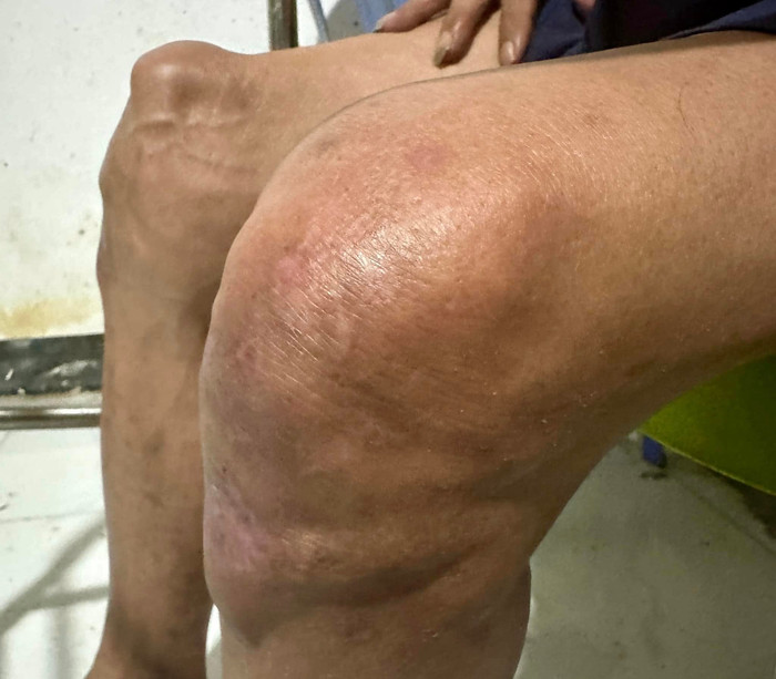 2 đầu gối của Thương Tín sưng tấy và biến dạng.
