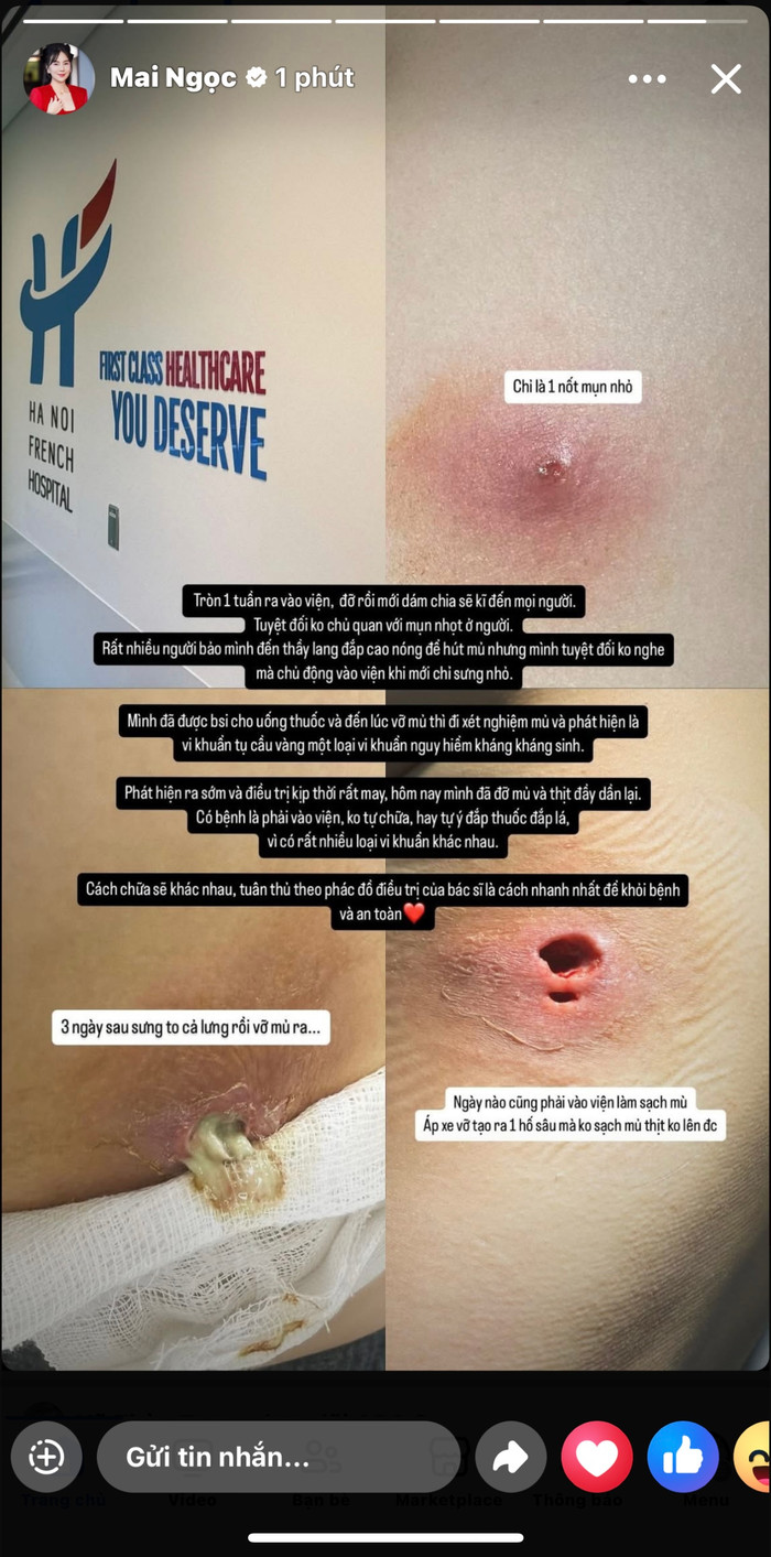 Vết thương Mai Ngọc đang dần hồi phục. Ảnh: FBNV