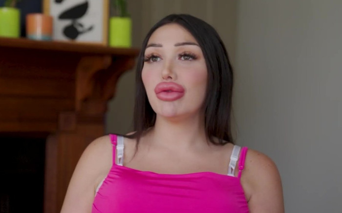 Cô gái bị cơ sở làm đẹp 'cấm cửa' vì tiêm môi to như 'bong bóng' Ảnh 2