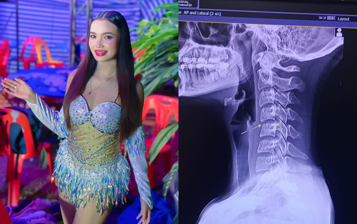 Hình chụp X-quang cho thấy Ping Chayada bị tổn thương đốt sống cổ. Theo chia sẻ, nữ ca sĩ đã đi massage cổ sau buổi biểu diễn nhưng không may bị nhân viên làm vẹo cổ, dẫn đến liệt toàn thân. (Ảnh: FBNV)