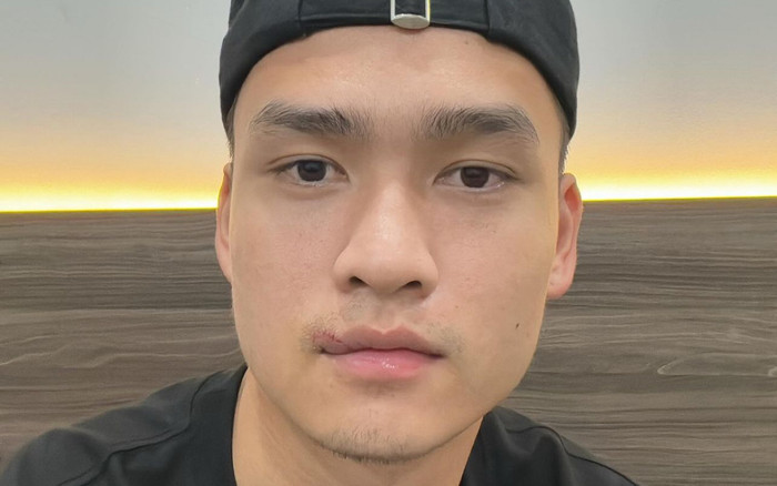 Cắt chỉ khâu 24 mũi, trung vệ Bùi Hoàng Việt Anh có diện mạo ra sao? Ảnh 2