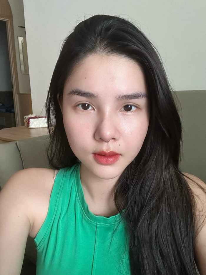 Nàng WAGs Kỳ Hân đã chia sẻ hình ảnh sau khi sửa mũi được 10 ngày. Ảnh: FBNV