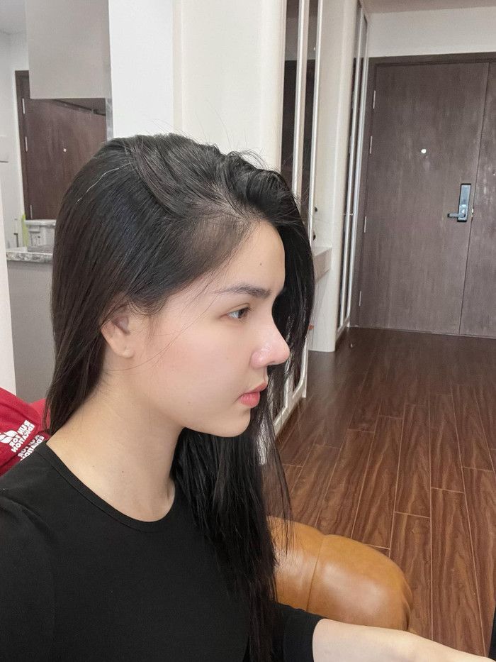 Hình ảnh mới nhất của Kỳ Hân sau ca phẫu thuật thẩm mỹ. Ảnh: FBNV