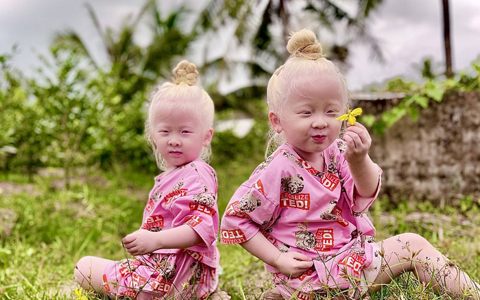 Bất ngờ cuộc sống mới của cặp song sinh đặc biệt ở Sóc Trăng từng gây bão mạng Ảnh 2