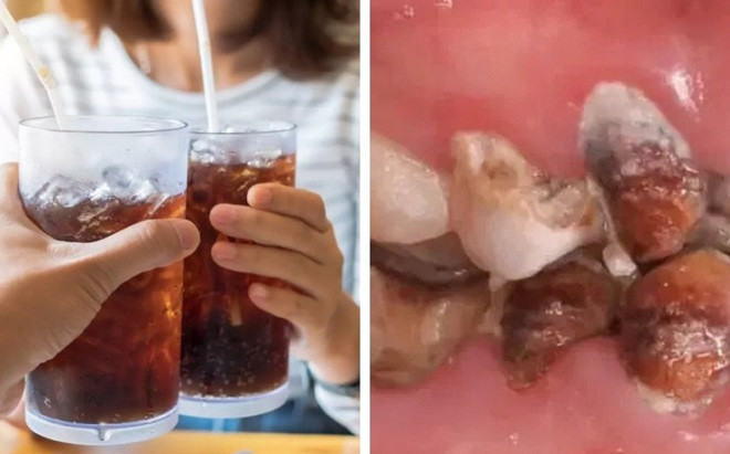 Cô gái tốn hơn nửa tỷ thay răng vì thứ nước nhiều bạn trẻ thường uống hàng ngày Ảnh 2