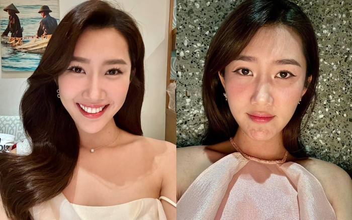 Nghi vấn Thúy Ngân gặp biến chứng sau khi 'trùng tu' nhan sắc. chi tiết lộ rõ trên mặt? Ảnh 2