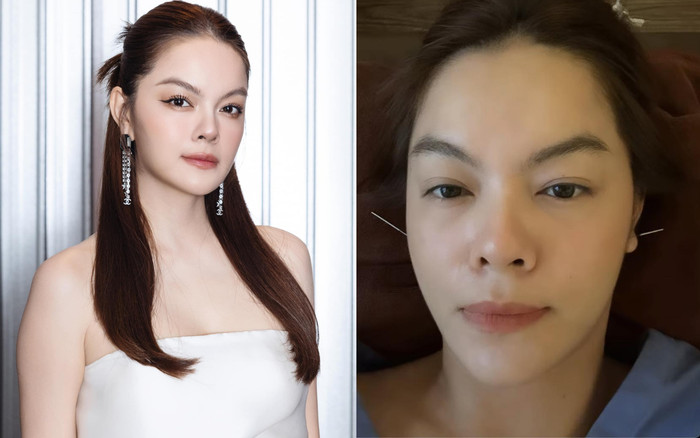 Phạm Quỳnh Anh gặp sự cố sức khoẻ, phải dùng kim châm để điều trị Ảnh 2