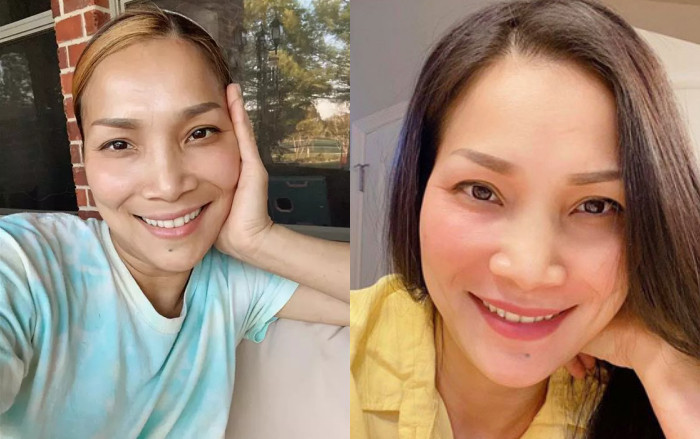 Nữ ca sĩ bị bỏng hết khuôn mặt do nổ nồi xông hơi, nhan sắc sau 4 năm gây ngỡ ngàng Ảnh 2