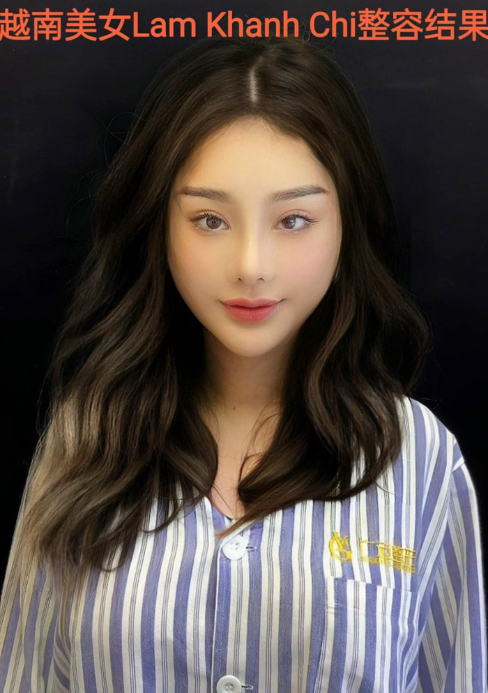 Hình ảnh Lâm Khánh Chi sau khi căng da mặt, cô lựa chọn thực hiện phương pháp này ở Trung quốc thay vì tại Hàn quốc như nữ diễn viên Quách Thu Phương. Ảnh: FBNV