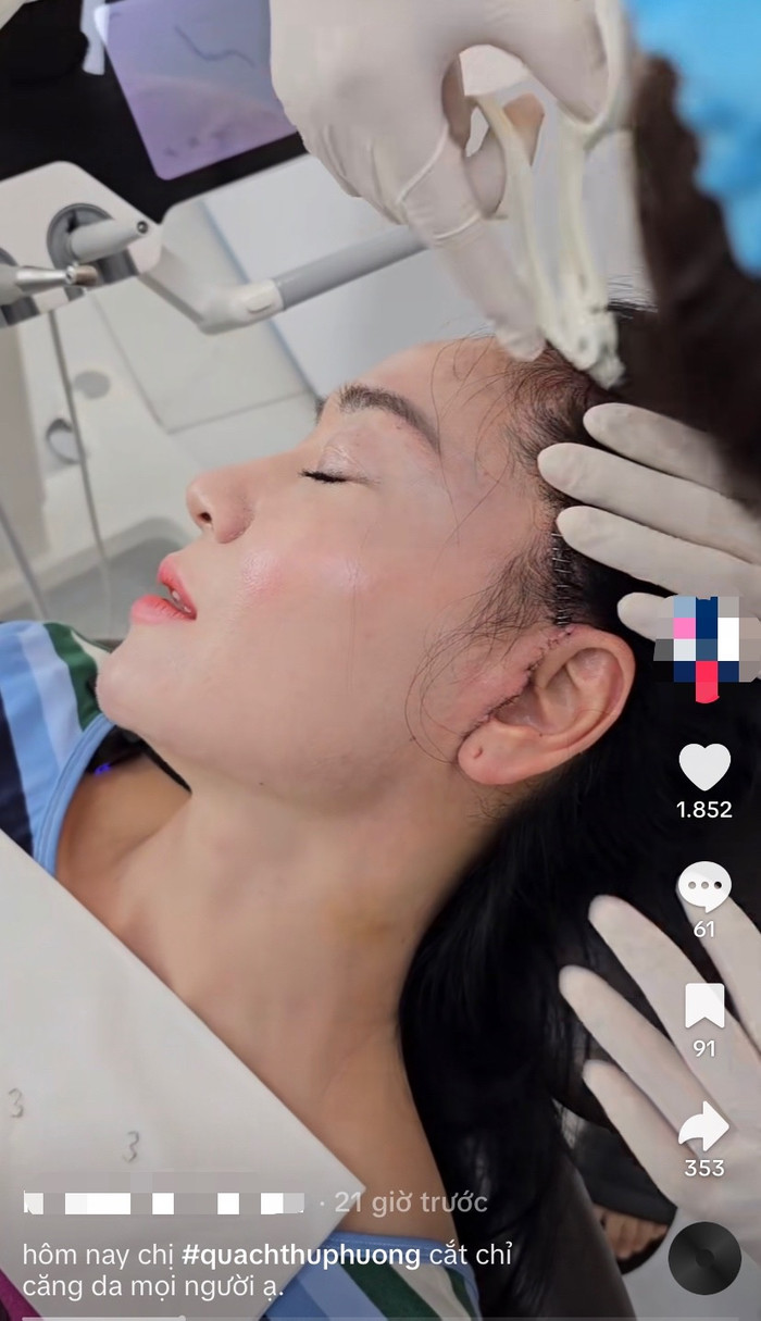 Vết sẹo trên khuôn mặt của nữ diễn viên Quách Thu Phương sau khi căng da làm cho nhiều khán giả lo sợ, bất ngờ. Ảnh: Chụp màn hình