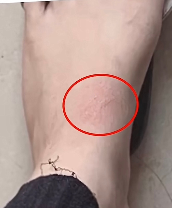 Dung dịch văng bắn tung toé, làm bỏng một số chỗ trên người.