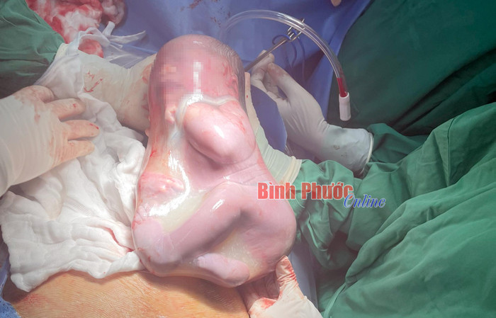 Hiện tượng em bé được sinh trong 'bọc điều' được cho là sẽ mang lại may mắn cho gia đình. Ảnh: Báo Bình Phước
