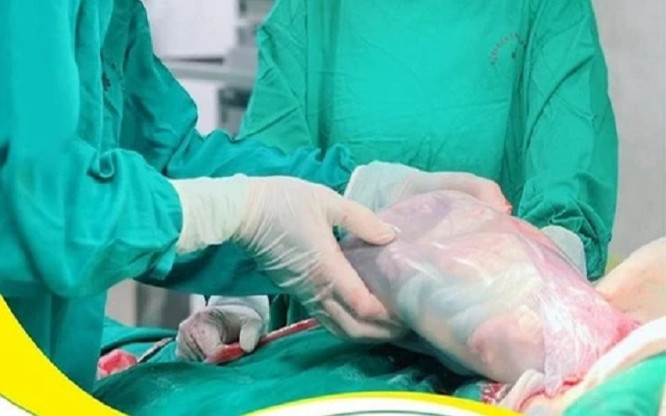 Thú vị em bé chào đời trong 'bọc điều' Ảnh 2
