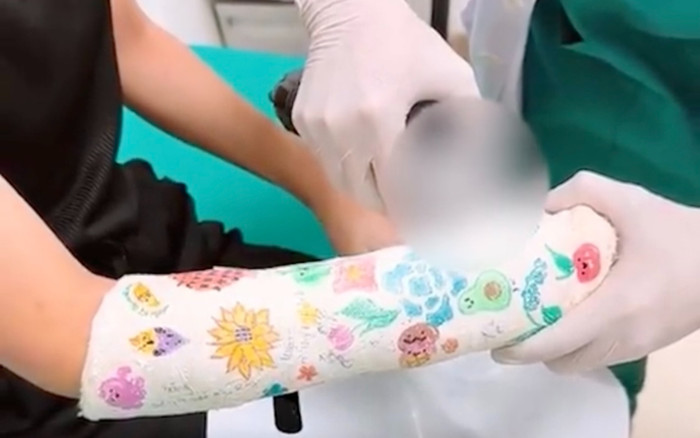 Vẽ lên bột trong lúc đang gãy tay, bé gái khiến bác sĩ không muốn tháo thành quả quá đẹp Ảnh 2