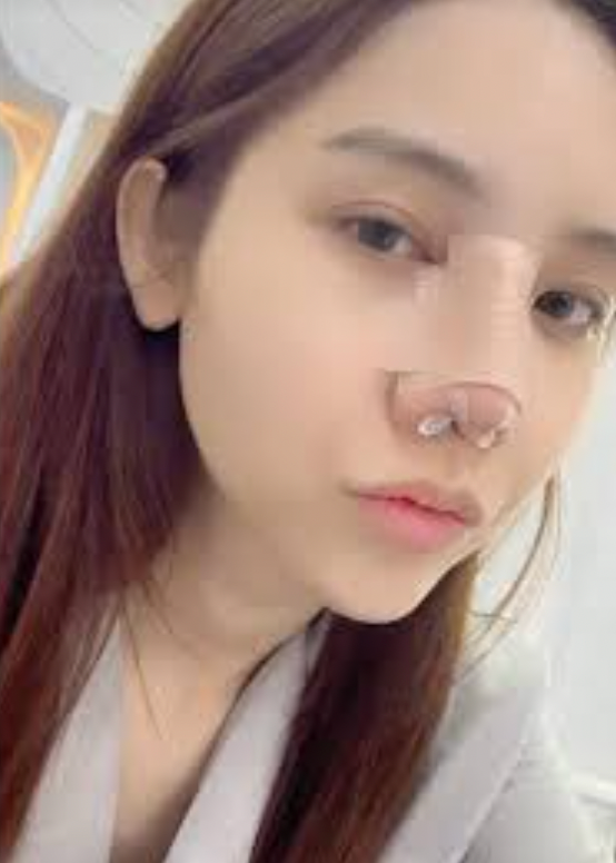 Đỗ Nhật Hà can thiệp 'dao kéo' phần mũi.