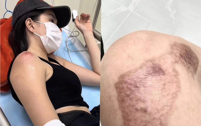 Ngọc Trinh tiết lộ số tiền điều trị chấn thương do tai nạn mô tô Ảnh 2