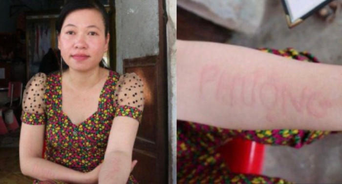 Với làn da 'độc lạ' chỉ cần sự 'tác động' nhỏ nào cũng khiến cho bề mặt da của chị Phượng bị nổi sưng lên.