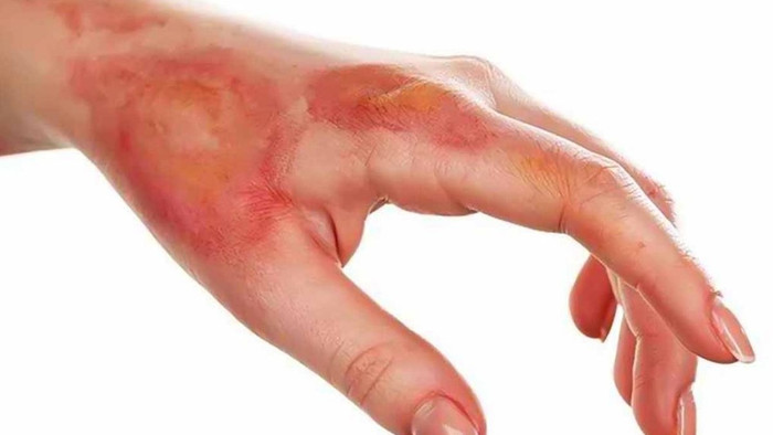 Nạn nhân bị bỏng cần sơ cứu kịp thời và đúng cách.