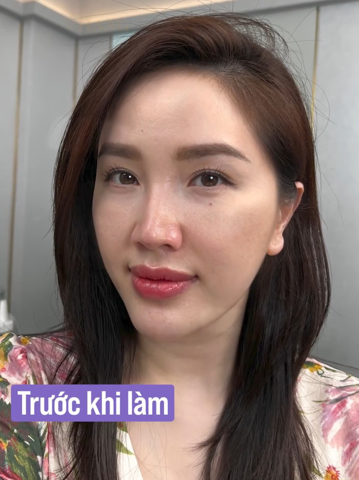 Mới đây, netizen đã truyền tay nhau hình ảnh ca sĩ Bảo Thy đến viện thẩm mỹ để trùng tu nhan sắc. Khác với độ đàn hồi, mơn mởn khi lên sóng, làn da thật của giọng ca Công chúa bong bóng khiến nhiều người bất ngờ. 