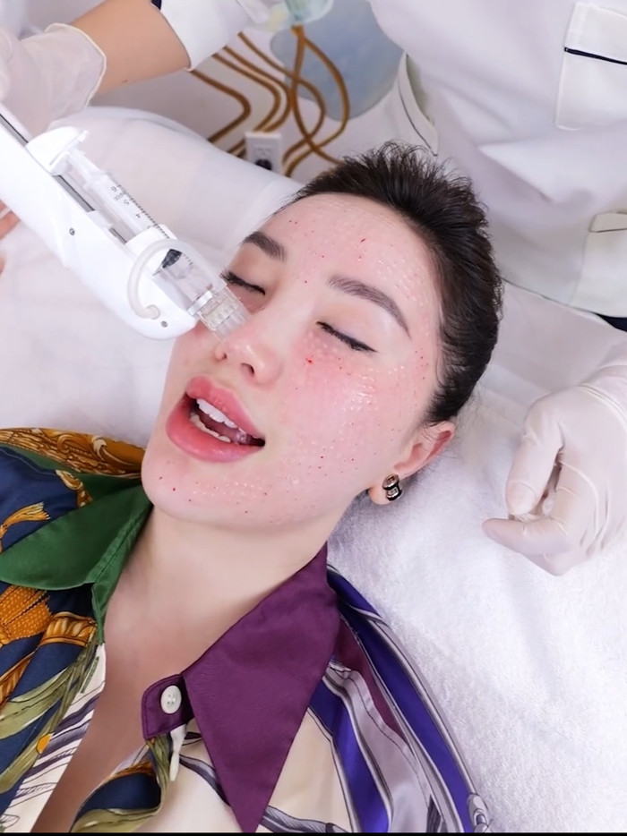 Được biết, Bảo Thy đã lựa chọn liệu trình xóa nám và trẻ hóa da theo phác đồ biocell plus. Cô sẽ tuần tự thực hiện bộ ba giải pháp gồm cấy tế bào tươi biocell plus, cấy vi điểm hydrat và laser frax pro. 