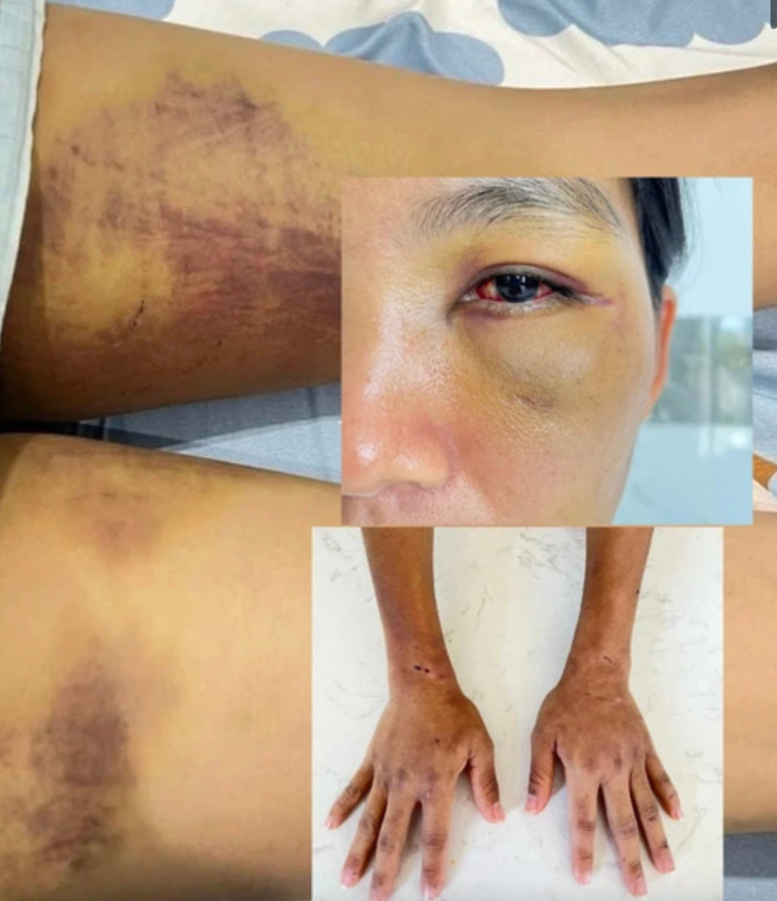 Trong suốt thời gian dài bị giam giữ, chị D bị gia đình chồng đánh đập, trên người đầy rẫy những vết thương.