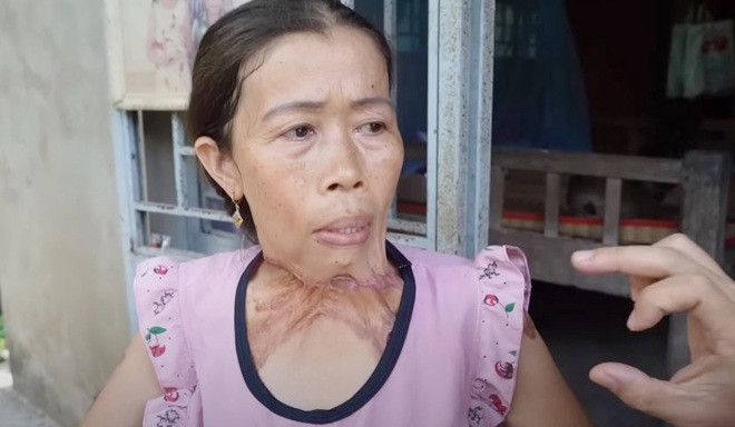 Chị Bé Nhỏ đau xót kể chuyện da thịt bỗng dính vào nhau