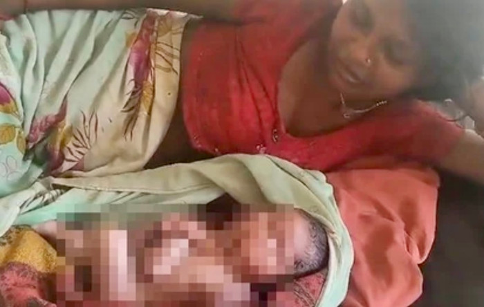 Bé sơ sinh có 2 gương mặt, 8 chân tay Ảnh 1