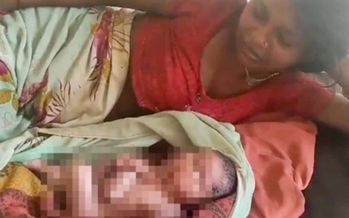 Bé sơ sinh có 2 gương mặt, 8 chân tay Ảnh 2